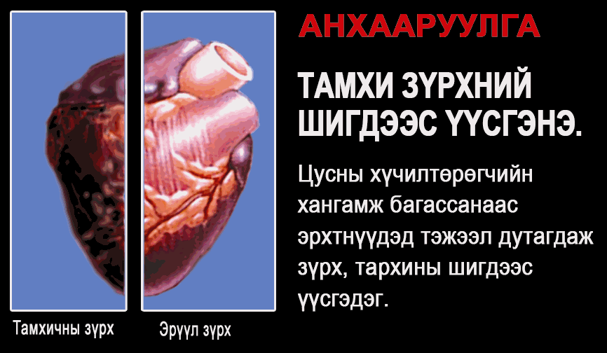 Mongolia 2010 Health Effects heart - diseased organ, heart disease